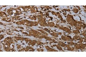 Immunohistochemistry of paraffin-embedded Human breast cancer using ARHGDIA Polyclonal Antibody at dilution of 1:30 (ARHGDIA anticorps)