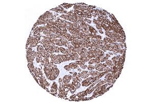 Squamous cell carcinoma of the uterine cervix with strong Cytokeratin 6 positivity (Recombinant Keratin 6 anticorps)