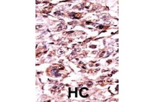 Formalin-fixed and paraffin-embedded human hepatocellular carcinoma tissue reacted with ABL1 (phospho Y245) polyclonal antibody  which was peroxidase-conjugated to the secondary antibody followed by AEC staining. (ABL1 anticorps  (pTyr245))