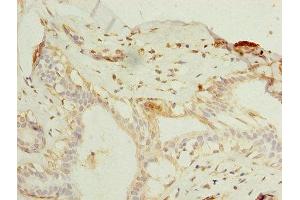 Immunohistochemistry of paraffin-embedded human breast cancer using ABIN7151487 at dilution of 1:100