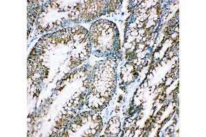 Anti-Cpn10 antibody, IHC(P) IHC(P): Human Intestinal Cancer Tissue