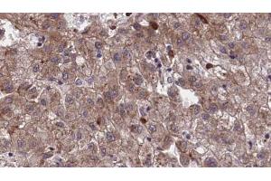 ABIN6273968 at 1/100 staining Human liver cancer tissue by IHC-P. (OR1I1 anticorps  (C-Term))