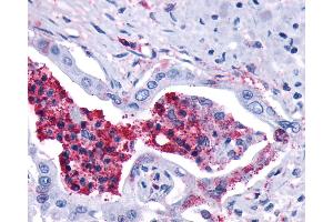 Anti-LTB4R2 / BLT2 antibody IHC of human Pancreas, Carcinoma and Leukocytes. (LTB4R2 anticorps  (C-Term))