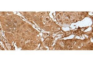 Immunohistochemistry of paraffin-embedded Human esophagus cancer tissue using LIPG Polyclonal Antibody at dilution of 1:50(x200) (LIPG anticorps)