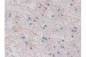 Detection of ANXA11 in Human Glioma Tissue using Polyclonal Antibody to Annexin A11 (ANXA11)
