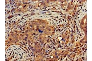 Immunohistochemistry of paraffin-embedded human pancreatic cancer using ABIN7149854 at dilution of 1:100 (DGAT1 anticorps  (AA 1-62))