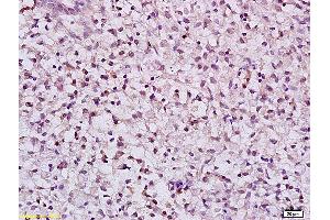 Formalin-fixed and paraffin embedded human gastric carcinoma labeled with Anti Phospho-MLK3(Thr277/Ser281) Polyclonal Antibody, Unconjugated (ABIN743963) at 1:200 followed by conjugation to the secondary antibody and DAB staining (MAP3K11 anticorps  (pSer281, pThr277))