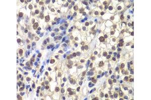Immunohistochemistry of paraffin-embedded Human kidney cancer using CENPC Polyclonal Antibody at dilution of 1:200 (40x lens). (Centromere Protein C Pseudogene 1 (CENPCP1) anticorps)