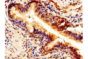 Immunohistochemistry of paraffin-embedded human lung cancer using ABIN7163691 at dilution of 1:100 (Pleiotrophin anticorps  (AA 33-168))