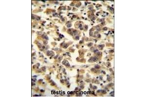 TTC39B antibody (C-term) (ABIN654972 and ABIN2844610) immunohistochemistry analysis in formalin fixed and paraffin embedded human testis carcinoma followed by peroxidase conjugation of the secondary antibody and DAB staining. (TTC39B anticorps  (C-Term))