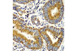 Immunohistochemistry of paraffin-embedded human colon carcinoma using TOMM20 antibody at dilution of 1:100 (x40 lens). (TOMM20 anticorps)