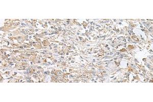 Immunohistochemistry of paraffin-embedded Human liver cancer tissue using PFKM Polyclonal Antibody at dilution of 1:60(x200) (PFKM anticorps)