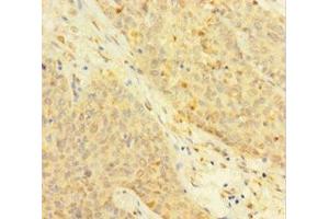 Immunohistochemistry of paraffin-embedded human ovarian cancer using ABIN7172118 at dilution of 1:100 (Thymidine Phosphorylase anticorps  (AA 13-254))