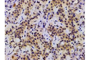 ABIN6277691 at 1/200 staining human duodenum cancer tissue sections by IHC-P. (Ephrin B2 anticorps  (C-Term))