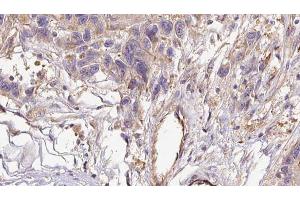 ABIN6273035 at 1/100 staining Human Melanoma tissue by IHC-P. (COL6A1 anticorps  (Internal Region))