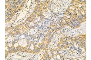 RPS23 Mouse Monoclonal Antibody at 1/100 staining human lung cancer and adjacent non-tumor tissue by IHC-P. (RPS23 anticorps  (N-Term))
