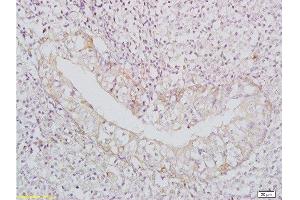 Formalin-fixed and paraffin-embedded: Human nasopharyngeal carcinoma labeled with Rabbit Anti-BAFF/CD257 Polyclonal Antibody, Unconjugated  1:400 followed by conjugation to the secondary antibody and DAB staining