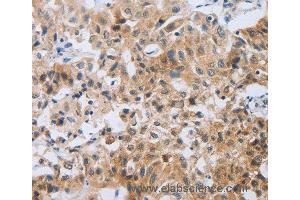 Immunohistochemistry of Human lung cancer using NEB Polyclonal Antibody at dilution of 1:80 (Nebulin anticorps)
