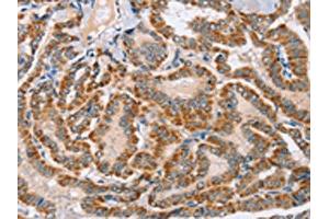 The image on the left is immunohistochemistry of paraffin-embedded Human thyroid cancer tissue using ABIN7130278(MSMB Antibody) at dilution 1/30, on the right is treated with fusion protein. (MSMB anticorps)