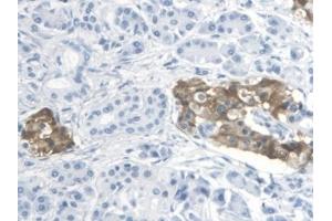 Detection of TP in Human Pancreatic cancer Tissue using Polyclonal Antibody to Thromboxane Receptor (TP)