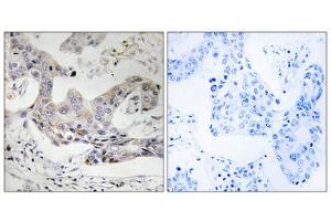 Immunohistochemistry analysis of paraffin-embedded human breast carcinoma tissue, using ALDH3B1 antibody. (ALDH3B1 anticorps  (Internal Region))
