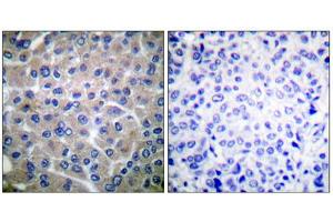 Immunohistochemical analysis of paraffin-embedded human breast carcinoma tissue using p130 Cas (epitope around residue 410) antibody (ABIN5976160).