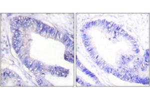 Immunohistochemistry analysis of paraffin-embedded human colon carcinoma, using IRS-1 (Phospho-Ser1101) Antibody.