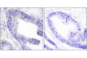 Immunohistochemistry analysis of paraffin-embedded human colon carcinoma, using IRS-1 (Phospho-Ser1101) Antibody. (IRS1 anticorps  (pSer1101))