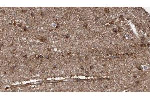 ABIN6279711 at 1/100 staining Human brain cancer tissue by IHC-P.