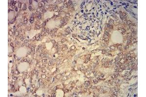 Immunohistochemical analysis of paraffin-embedded cervical cancer tissues using KAT2B mouse mAb with DAB staining.