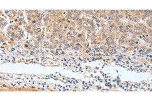 Immunohistochemistry of paraffin-embedded Human lung cancer tissue using BPIFB2 Polyclonal Antibody at dilution 1:45