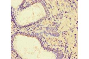 Immunohistochemistry of paraffin-embedded human prostate cancer using ABIN7162730 at dilution of 1:100