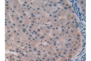 Detection of CC16 in Human Liver cancer Tissue using Polyclonal Antibody to Clara Cell Protein 16 (CC16)