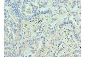Immunohistochemistry of paraffin-embedded human lung cancer using ABIN7155474 at dilution of 1:100