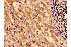 Immunocytochemistry analysis of human liver cancer using ABIN7171000 at dilution of 1:100 (SOCS3 anticorps  (AA 1-224))