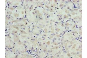 Immunohistochemistry of paraffin-embedded human gastric cancer using ABIN7164554 at dilution of 1:100 (SLC31A2 anticorps  (AA 44-93))
