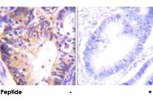 Immunohistochemical analysis of paraffin-embedded human colon carcinoma tissue using PAK1 polyclonal antibody . (PAK1 anticorps)