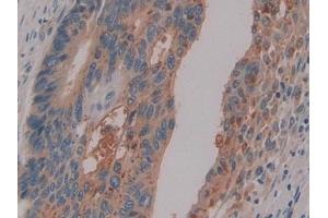 Detection of PSG1 in Human Colorectal cancer Tissue using Polyclonal Antibody to Pregnancy Specific Beta-1-Glycoprotein 1 (PSG1) (PSG1 anticorps  (AA 202-401))