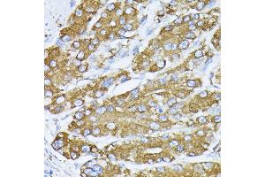 Immunohistochemistry of paraffin-embedded human liver cancer using BiP/GRP78 antibody (ABIN3020762, ABIN3020763, ABIN3020764, ABIN1512637 and ABIN6213711) at dilution of 1:100 (40x lens).