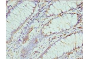 Immunohistochemistry of paraffin-embedded human colon cancer using ABIN7174682 at dilution of 1:100