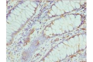 Immunohistochemistry of paraffin-embedded human colon cancer using ABIN7174682 at dilution of 1:100 (Cytidine Monophosphate (UMP-CMP) Kinase 1, Cytosolic (CMPK1) (AA 37-196) anticorps)