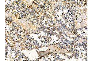 RNF87 Antibody at 1/100 staining human ovarian cancer by IHC-P. (TRIM4 anticorps)