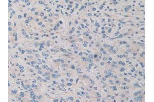 IHC-P analysis of Human Prostate Gland Cancer Tissue, with DAB staining. (PDHX anticorps  (AA 220-468))