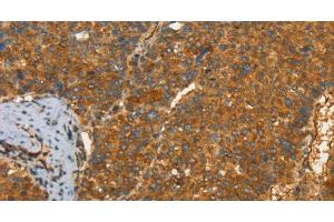 Immunohistochemistry of paraffin-embedded Human liver cancer tissue using PFKFB1 Polyclonal Antibody at dilution 1:60