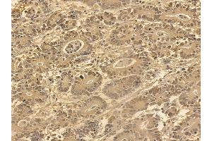 FOXO4 Mouse Monoclonal Antibody at 1/100 staining human colorectal cancer by IHC-P. (FOXO4 anticorps  (Internal Region))