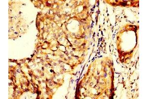 IHC image of ABIN7144013 diluted at 1:300 and staining in paraffin-embedded human cervical cancer performed on a Leica BondTM system.