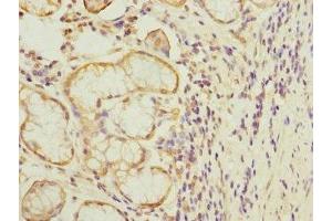 Immunohistochemistry of paraffin-embedded human gastric cancer using ABIN7172732 at dilution of 1:100 (MTERFD1 anticorps  (AA 69-300))