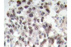 Immunohistochemistry analyzes of PDCD4 antibody in paraffin-embedded human breast carcinoma tissue. (PDCD4 anticorps)