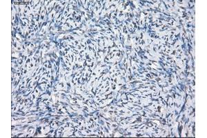 Immunohistochemical staining of paraffin-embedded Adenocarcinoma of breast tissue using anti-SLC7A8 mouse monoclonal antibody.
