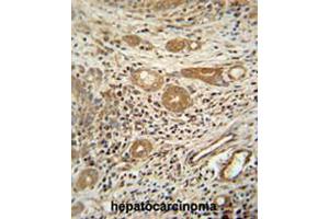 CTSA antibody (N-term) immunohistochemistry analysis in formalin fixed and paraffin embedded human hepatocarcinoma followed by peroxidase conjugation of the secondary antibody and DAB staining. (CTSA anticorps  (N-Term))